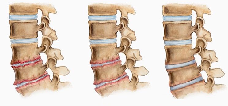 Az osteochondrosisban az intervertebralis lemezek deformációja hátfájást okozhat