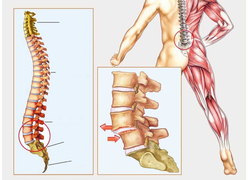 egészséges és beteg gerinc