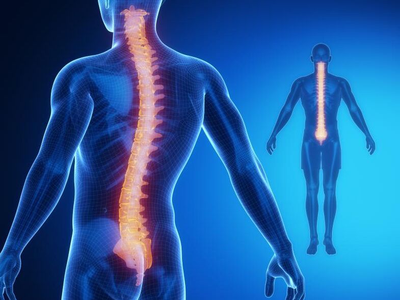 A gerincoszlop osteochondrosisa, amely komplex kezelést igényel