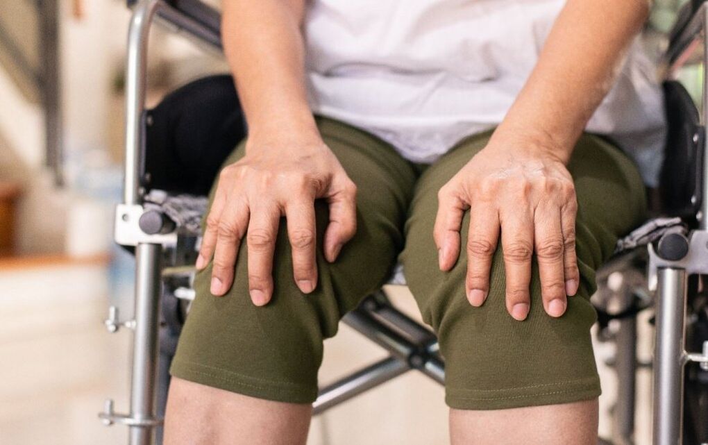 A térdízületek arthrosisában szenvedő beteg
